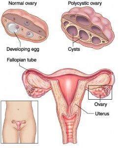 PCOS（多嚢胞性卵巣症候群）はOHSSのリスクファクターの一つです。